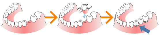 インプラントとブリッジと入れ歯の比較　入れ歯