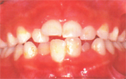 下の前歯は４本生えているが、重なっている。上は前歯が生え変わらないで、乳歯が残ったままになっている。