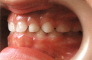 マウスピースで改善された正常な歯並び